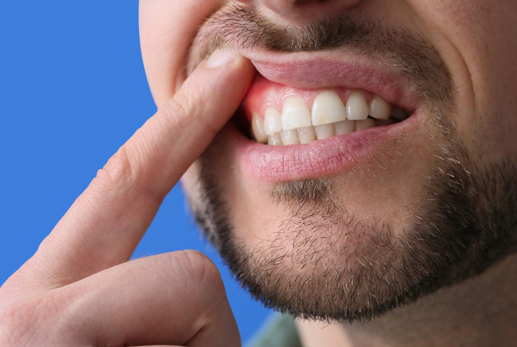 Periodontal Disease treatment