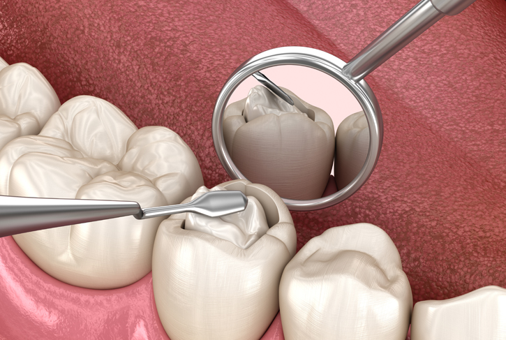 Patients Prefer Dentist Composite Filling