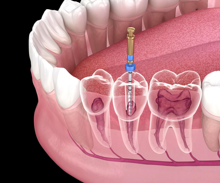 Signs You Might Need a Root Canal